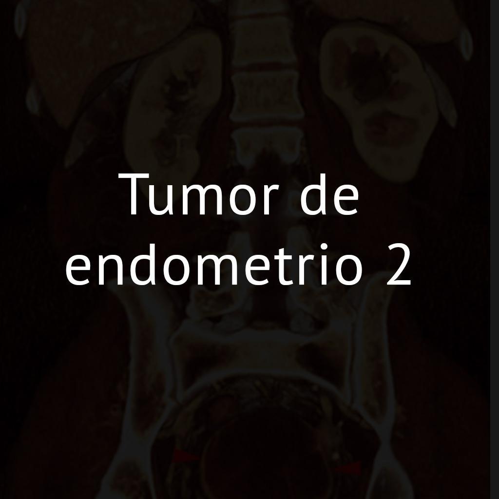 Tumor de endometrio 2