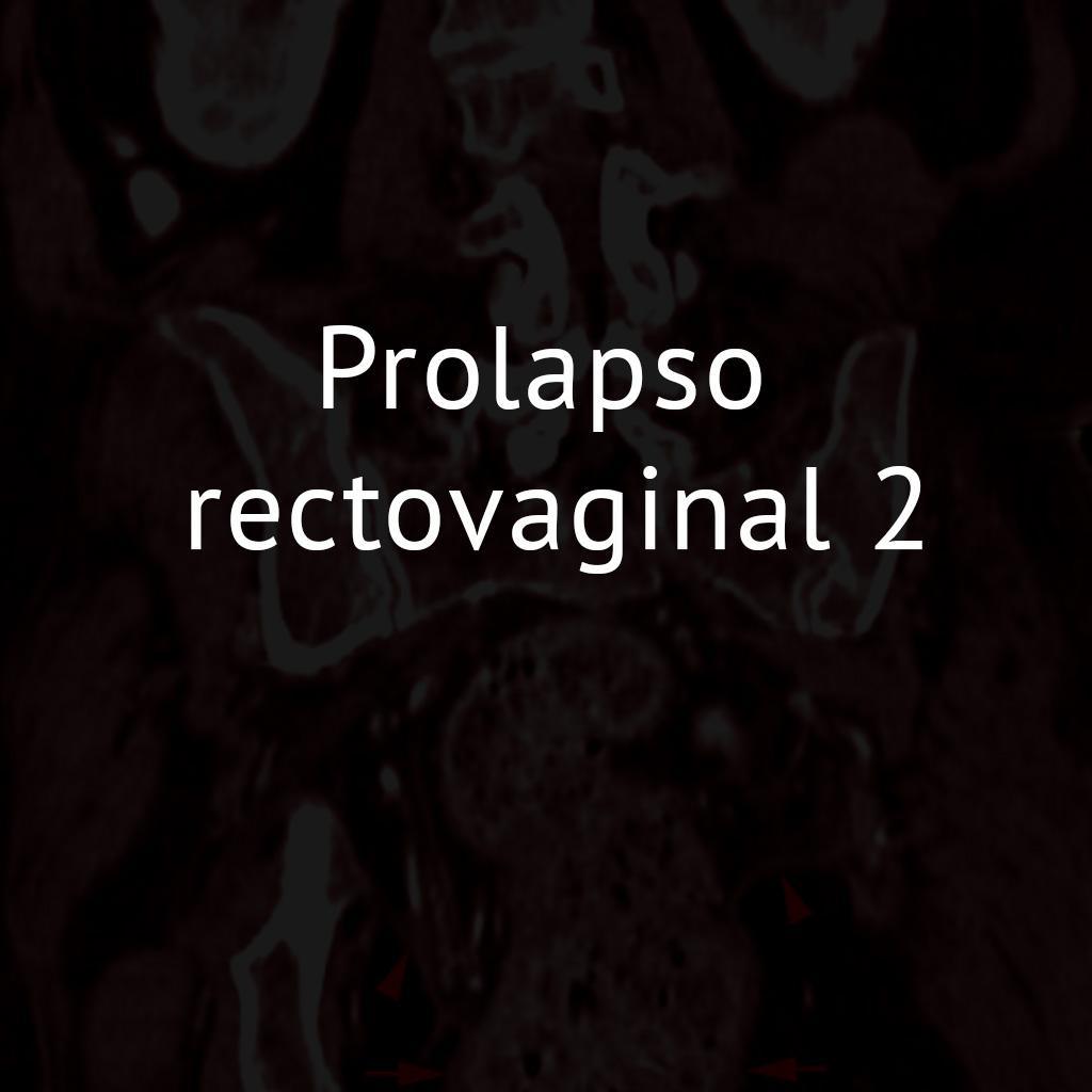 Prolapso rectovaginal 2