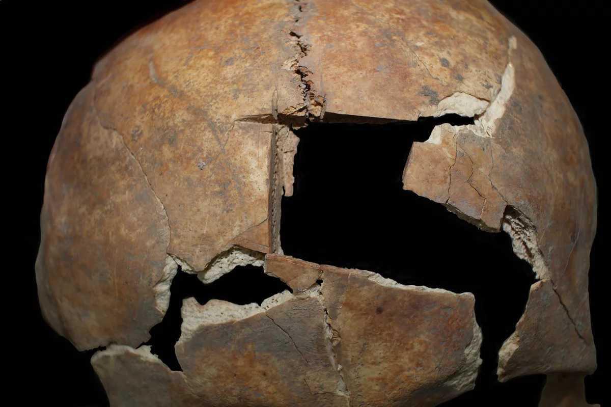 EVIDENCE OF BRONZE AGE CRANIAL SURGERY FOUND AT ANCIENT MEGIDDO EVIDENCE OF BRONZE AGE CRANIAL SURGERY FOUND AT ANCIENT MEGIDDO