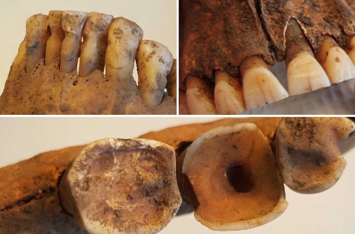 Dentistry during Viking Age was surprisingly advanced