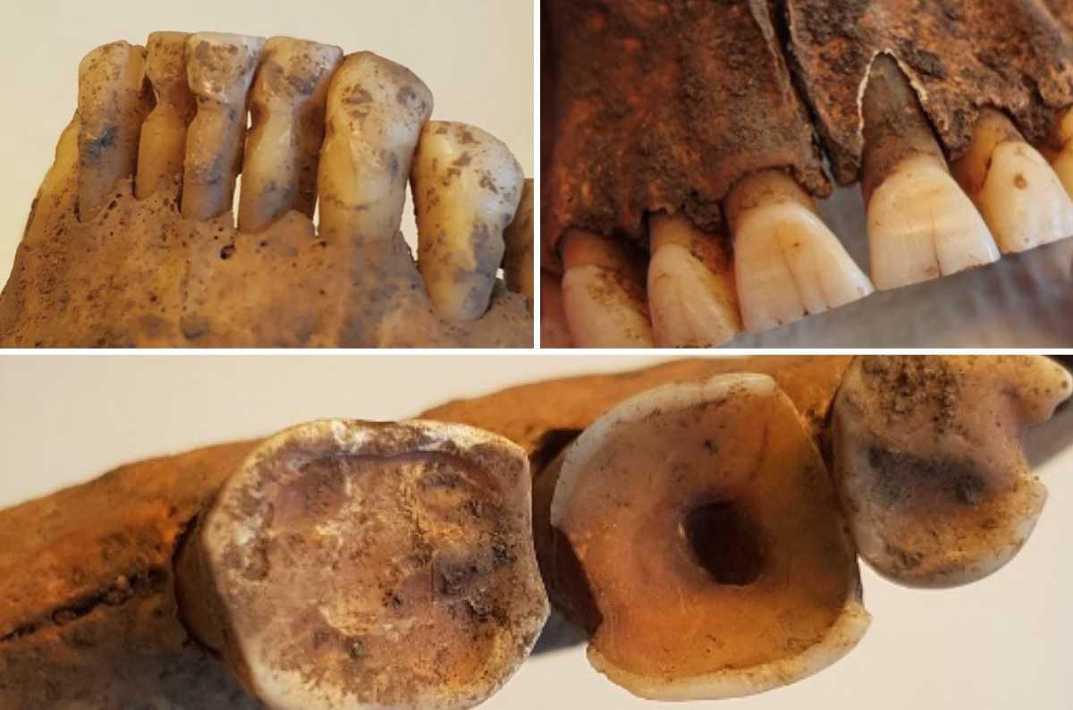 Dentistry during Viking Age was surprisingly advanced Dentistry during Viking Age was surprisingly advanced
