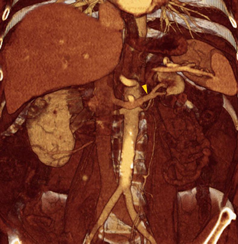 Hipoplasia renal 2