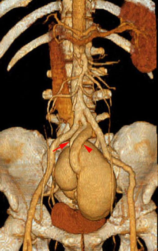 Riñón único pélvico