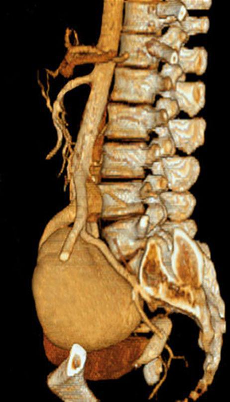 Riñón único pélvico