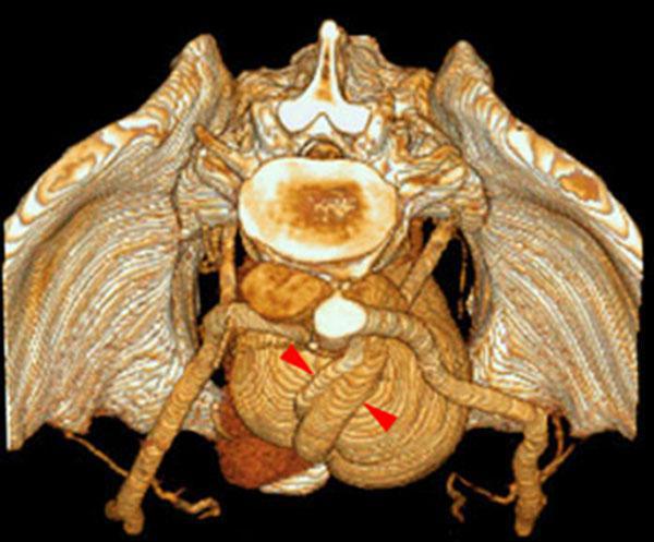 Riñón único pélvico