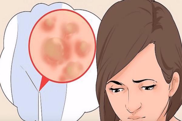 Verrugas Genitales o Condilomas 🌝