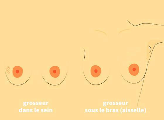 Quels sont les symptômes ? Quels sont les symptômes ?