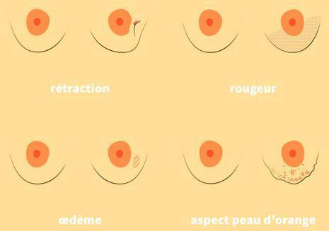 Quels sont les symptômes ? Quels sont les symptômes ?