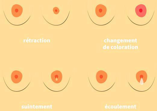 Quels sont les symptômes ? Quels sont les symptômes ?