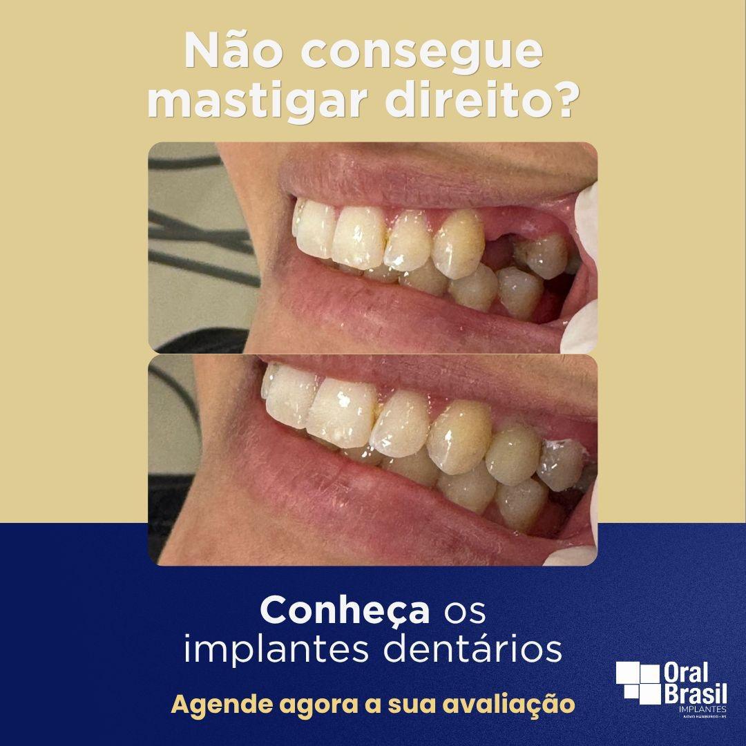 Avaliação cortesia com Raio X + 5% desconto no seu Implante. Avaliação cortesia com Raio X + 5% desconto no seu Implante.
