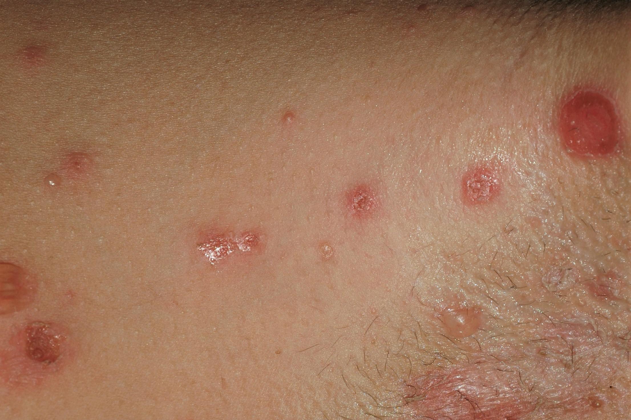 Cura tus Axilas con Ampollas_2 Ampollas en las axilas_2