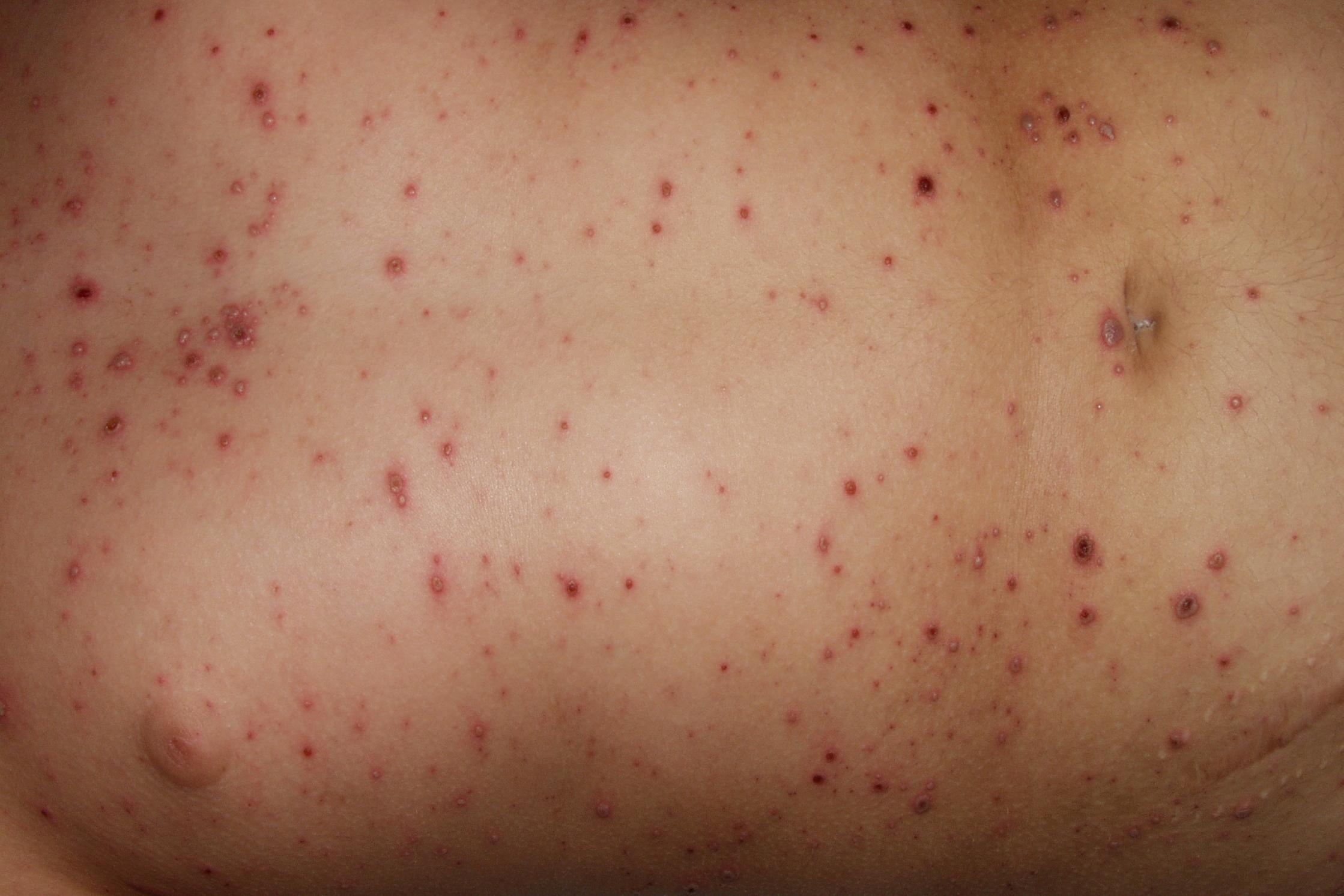 04. INFECCIONES VÍRICAS