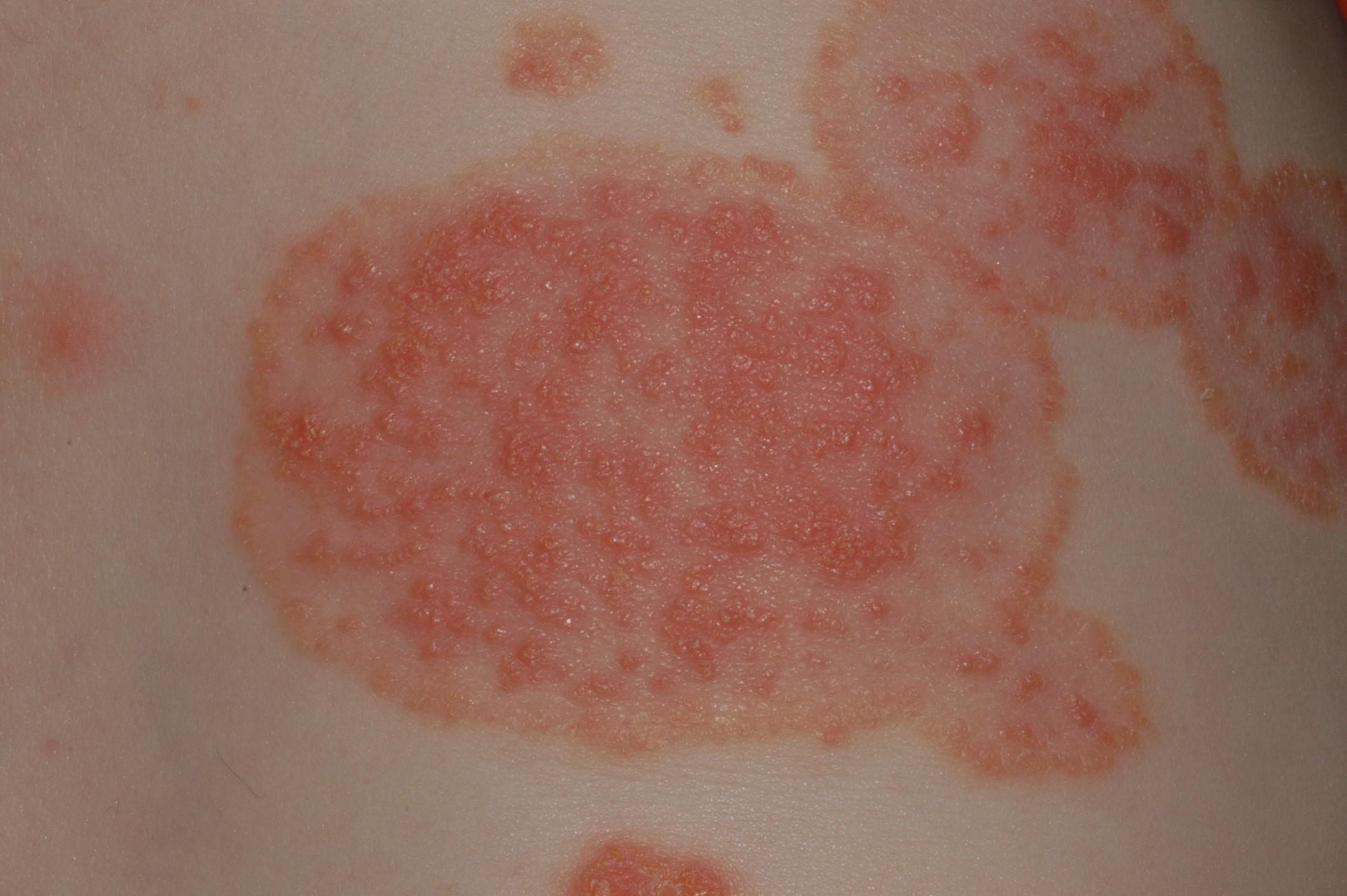Qu Es Micosis Cut nea Candidiasis Cut nea MedlinePlus Enciclopedia qu-es-micosis-cut-nea-candidiasis-cut-nea-medlineplus-enciclopedia