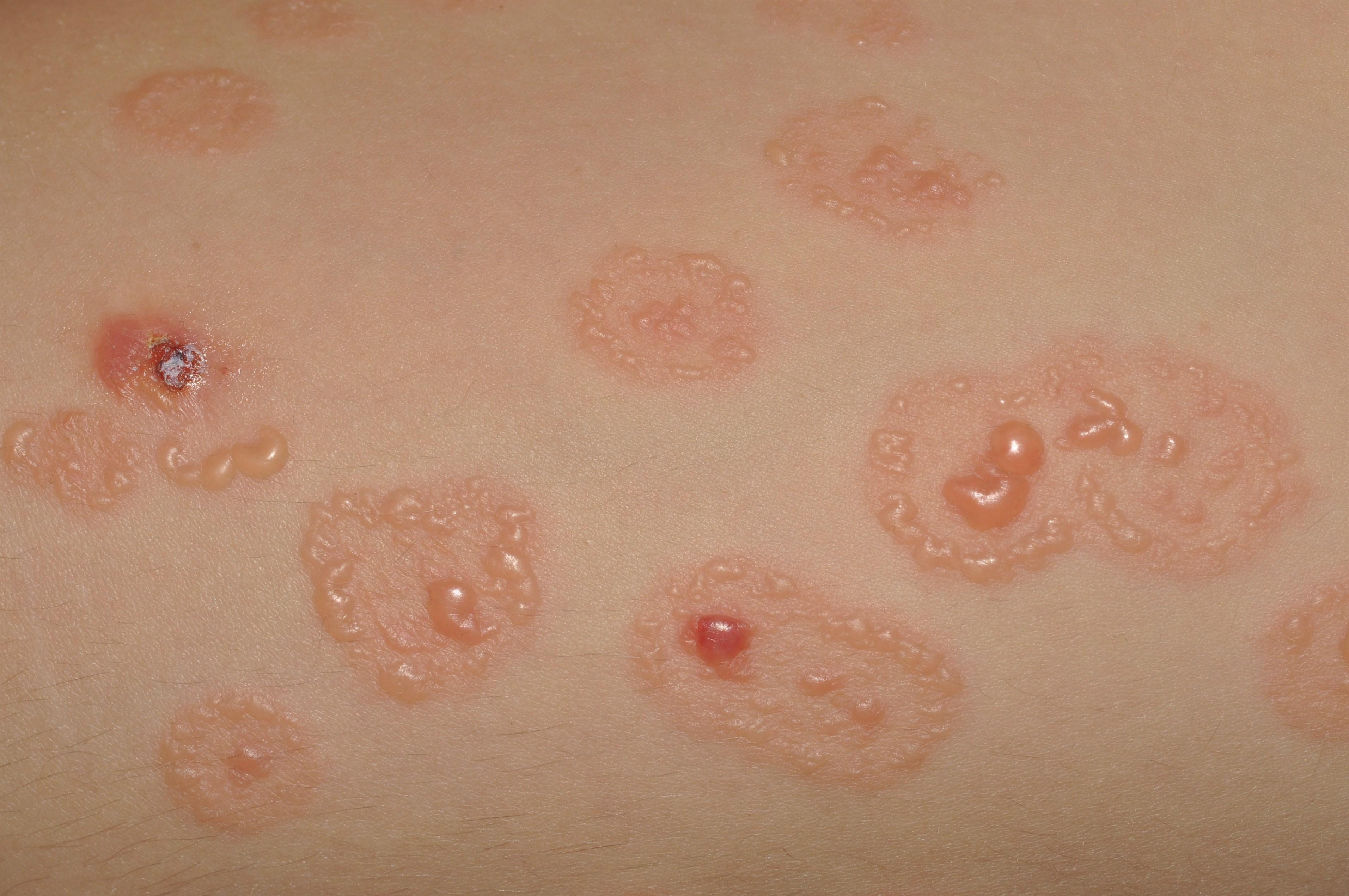 08. DERMATOSIS VESICULOSAS Y AMPOLLOSAS