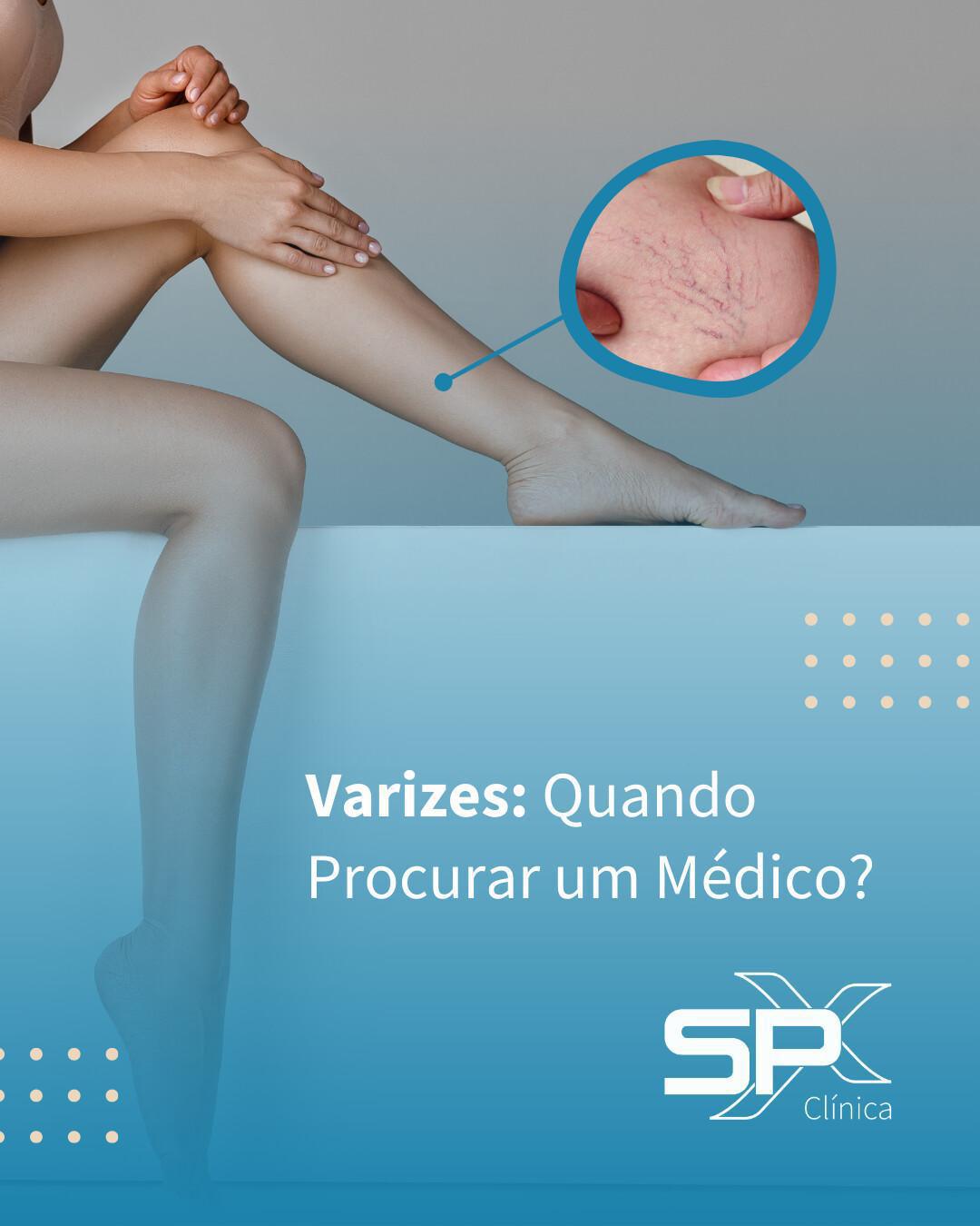 🦵🏻 Varizes: Quando Procurar um Médico? 👨🏻‍⚕️