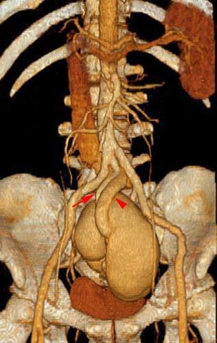 Riñón único pélvico