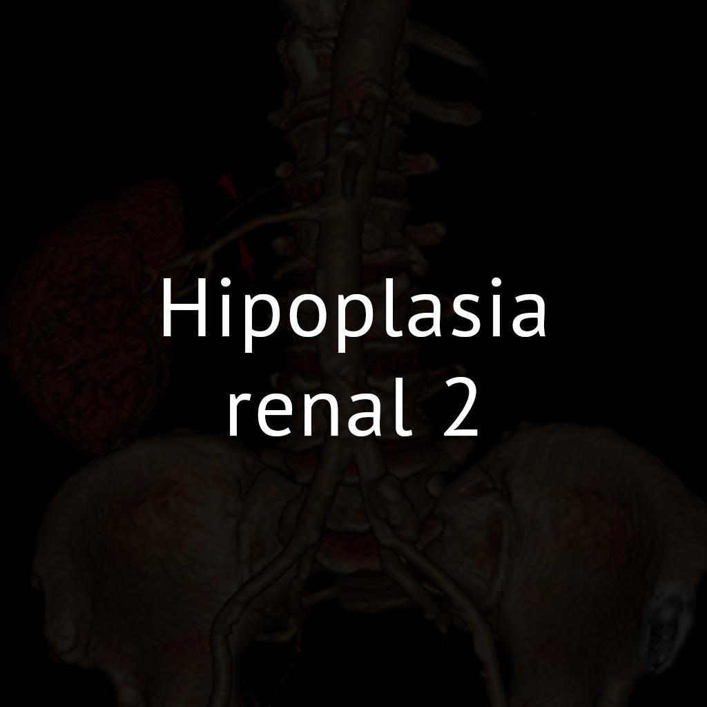 Hipoplasia renal 2