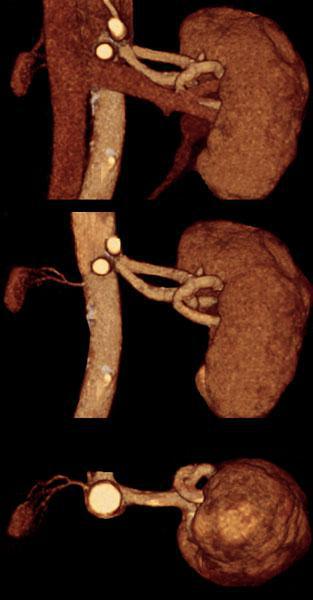 Hipoplasia renal 1
