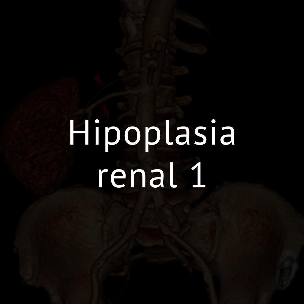 Hipoplasia renal 1