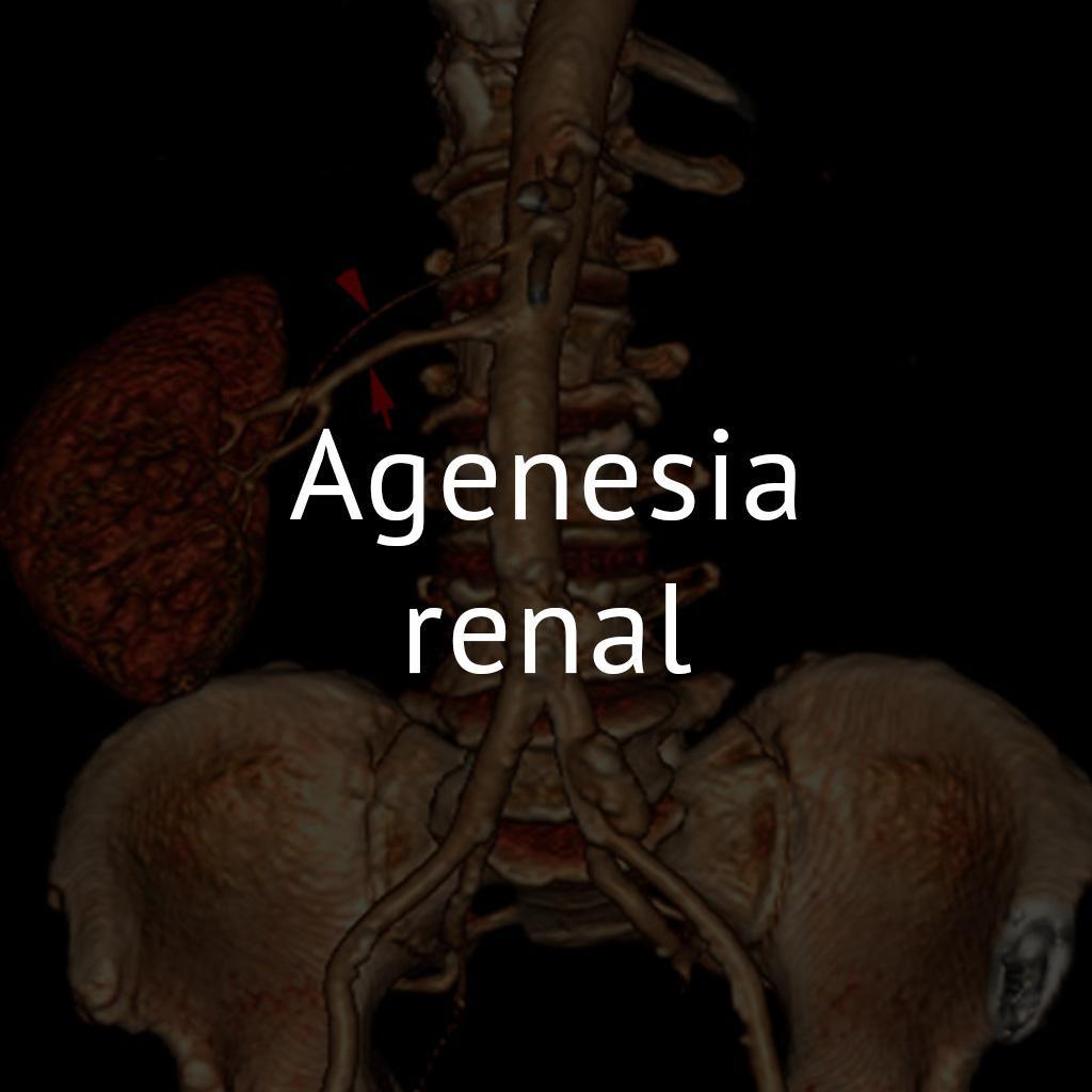 Agenesia Renal