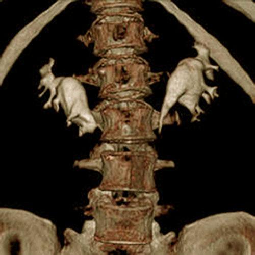 Malrotación renal en riñón en herradura