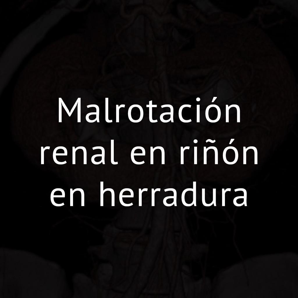 Malrotación renal en riñón en herradura