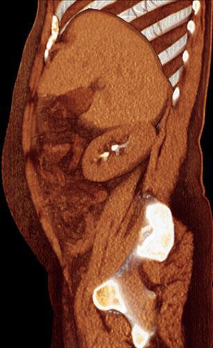 Riñón horizontalizado