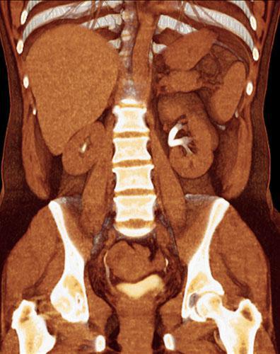 Riñón horizontalizado