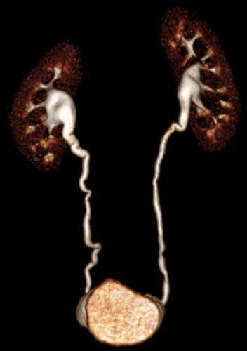 Malrotación renal anterior