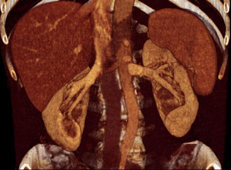 Malrotación renal anterior