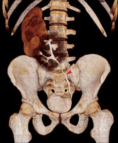 Ectopia renal cruzada con anomalía de sínfisis