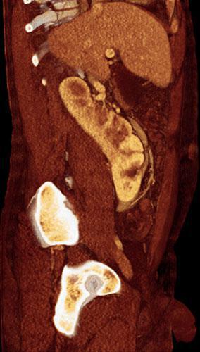 Ectopia renal cruzada con anomalía de sínfisis