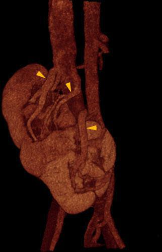 Ectopia renal cruzada con anomalía de sínfisis