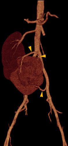 Ectopia renal cruzada con anomalía de sínfisis