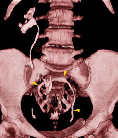 Ectopia renal cruzada