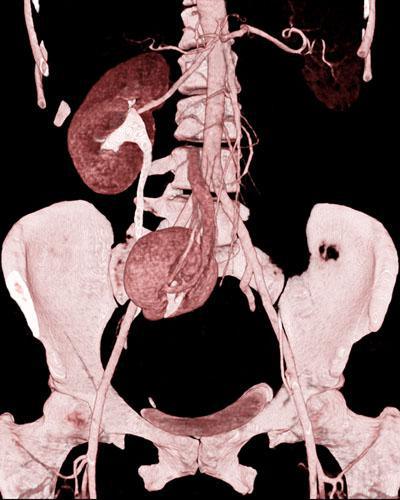 Ectopia renal cruzada