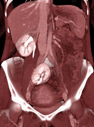 Ectopia renal cruzada