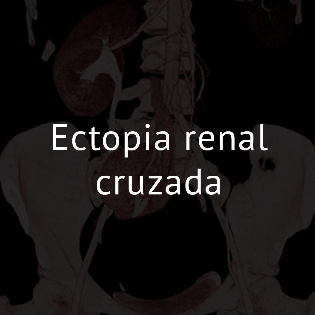 Ectopia renal cruzada