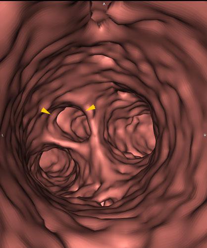 Ectopia renal pélvica