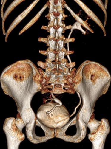 Ectopia renal pélvica