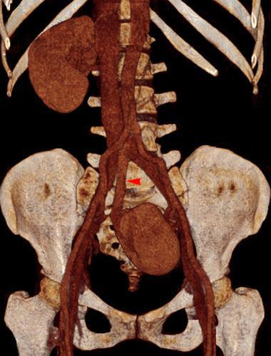 Ectopia renal pélvica