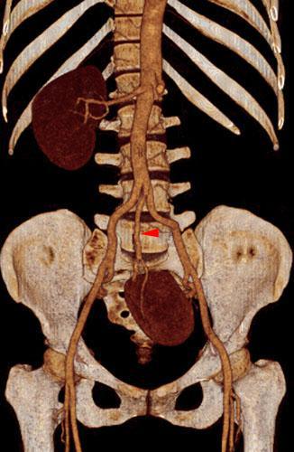 Ectopia renal pélvica