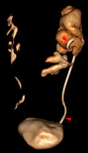 Riñón en herradura. Obstrucción por litiasis ureteral