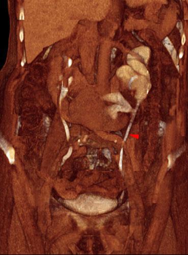 Riñón en herradura. Obstrucción por litiasis ureteral