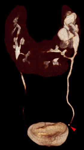 Riñón en herradura. Obstrucción por litiasis ureteral