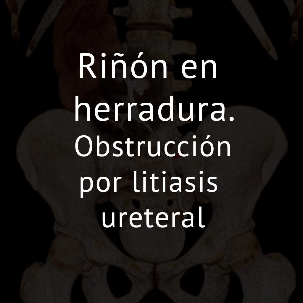 Riñón en herradura. Obstrucción por litiasis ureteral