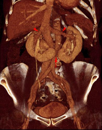 Riñón en herradura con puente fibroso