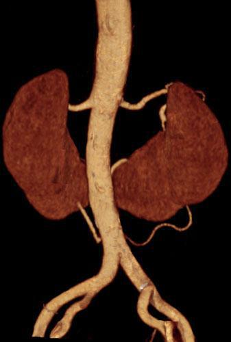 Riñón en herradura con puente fibroso
