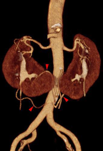 Riñón en herradura con puente fibroso