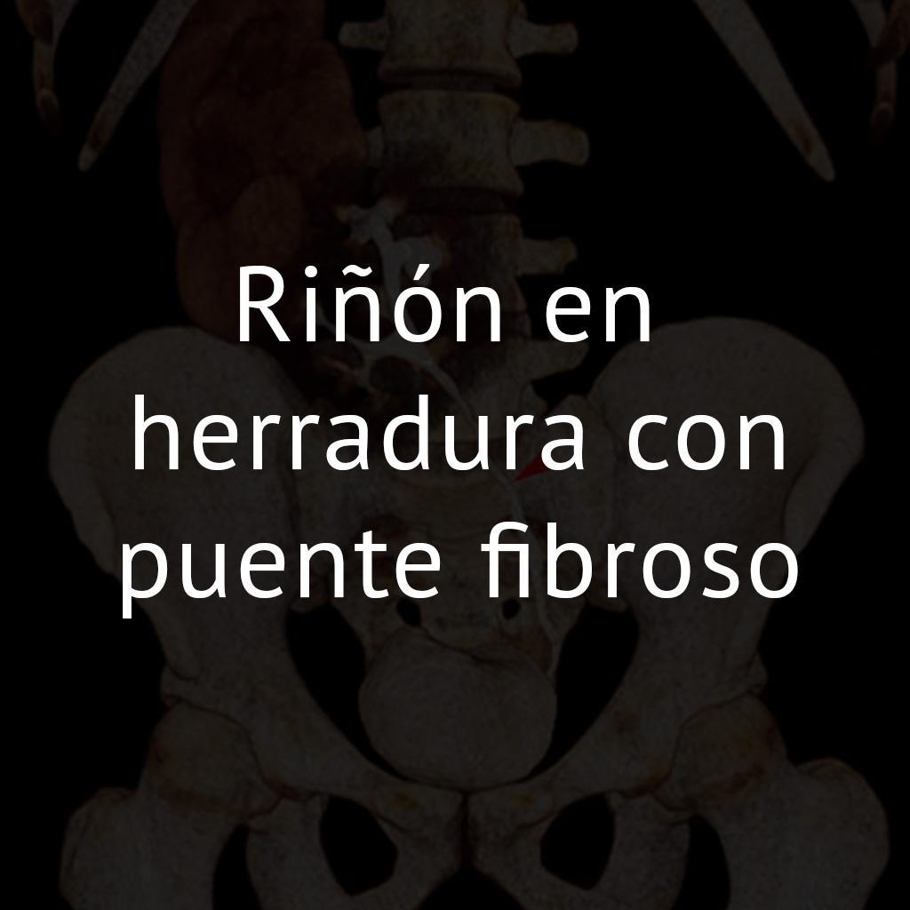 Riñón en herradura con puente fibroso